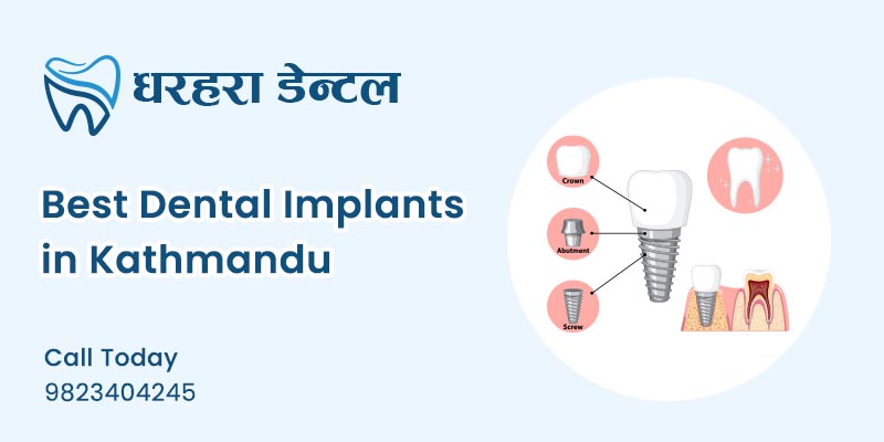 Best Dental Implant in Kathmandu