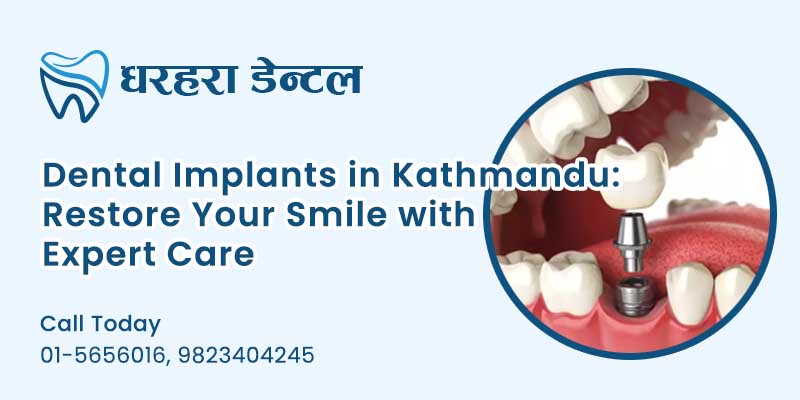 Dental Implants in Kathmandu