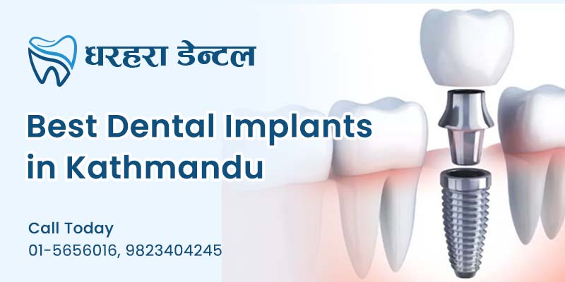 Best Dental Implants in Kathmandu