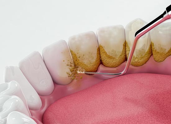 Dental Scaling: Myths vs Facts
