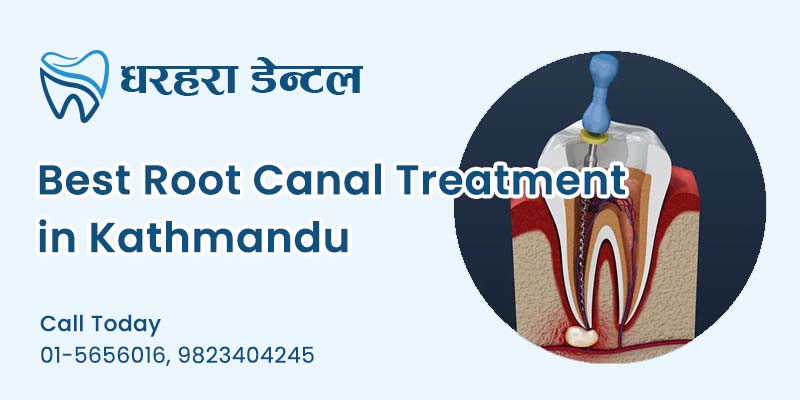 Best Root Canal Treatment in Kathmandu
