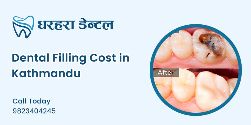 Dental Filling Cost in Kathmandu